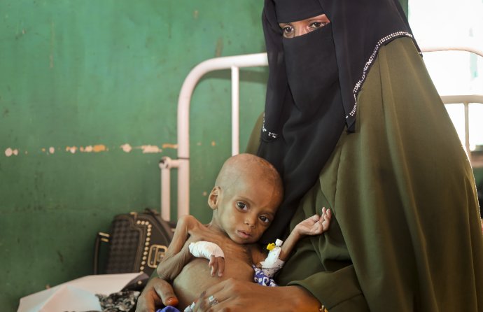 Hladujúce 9-mesačné dieťa v Somálsku. Foto – TASR/AP