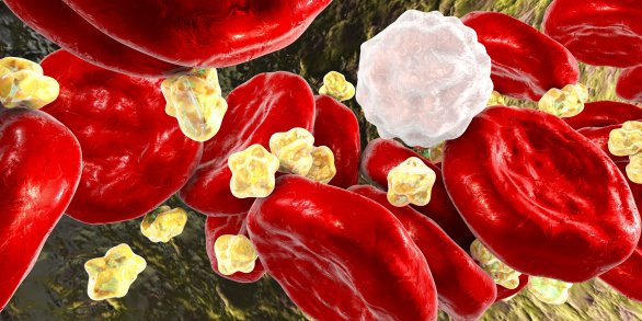 Rozvoj srdcovocievneho ochorenia kvôli hromadeniu cholesterolu. Ilustračné foto – Adobe Stock