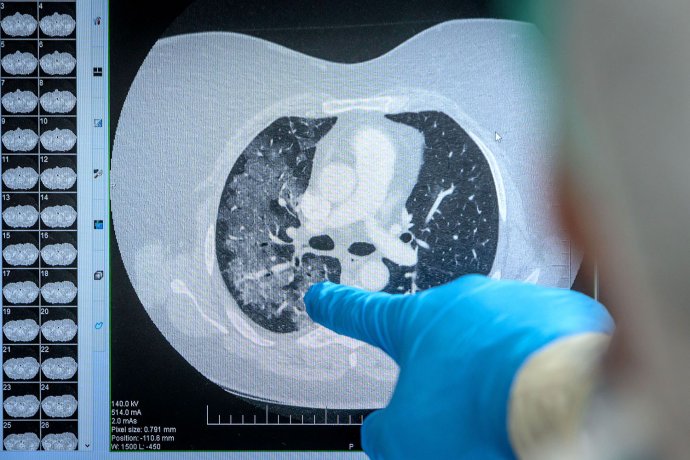 Ako vyzerá zápal pľúc. Foto N – Tomáš Benedikovič
