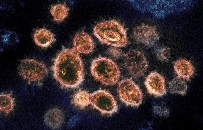 Vírus SARS-CoV-2 pod elektrónovým mikroskopom. Foto – NIAID-RML