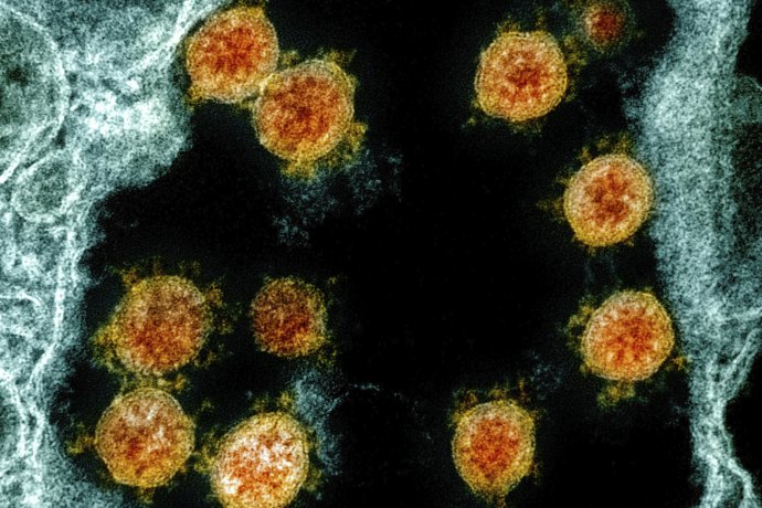 Vírus pod elektrónovým mikroskopom, kolorizované. Foto - tasr/ap
