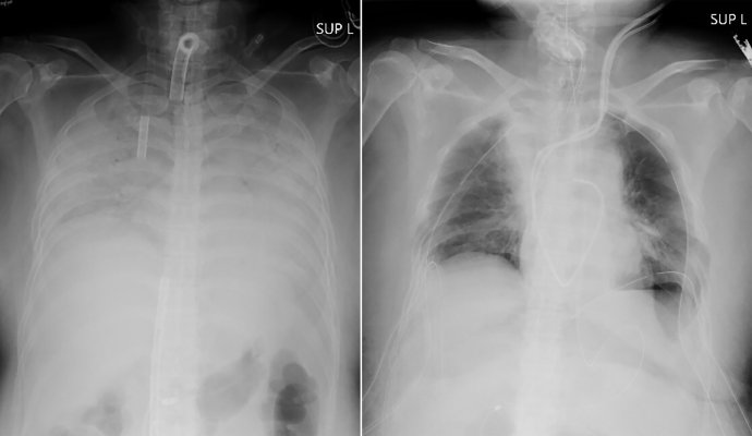 Kombinácia röntgenových snímok pacienta pred transplantáciou pľúc, vynútenou covidom-19 (vľavo), a po zákroku (vpravo). Foto - TASR/AP/Kjótska univerzita
