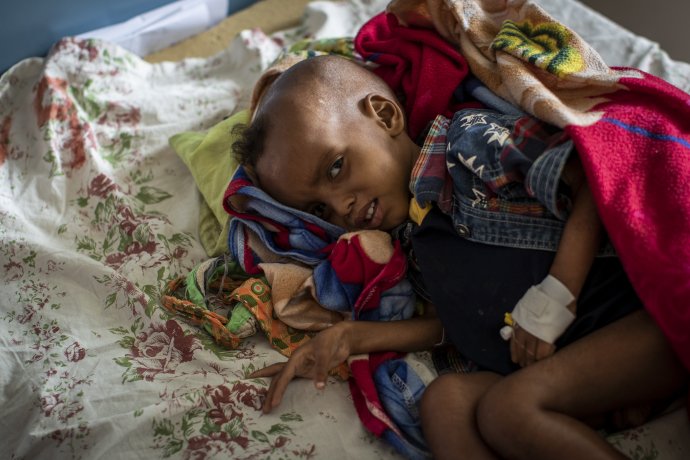 Podvýživené dvojročné dieťa v nemocnici v meste Mekele. Foto - TASR/AP