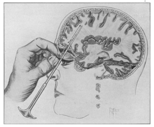 Freeman W.: Transorbital Leukocomy: The Deep Frontal Cut. 1949