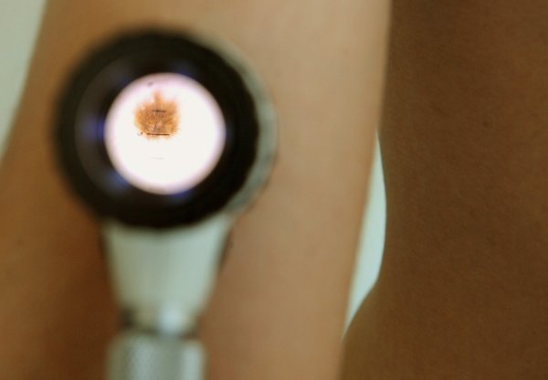 Kľúčový liek, ktorý zachraňuje život pacientom s&nbsp;rakovinou kože, štát stále neuhrádza všetkým