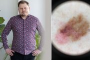 Znamienko si všimla manželka, na kožnom som nebol desať rokov, hovorí Matej Bista, ktorému zistili melanóm